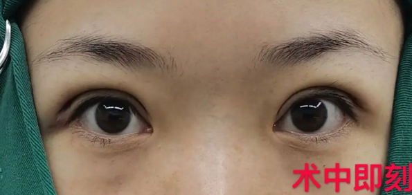 北京八大处整形医院郭时伟医生双眼皮怎么样?