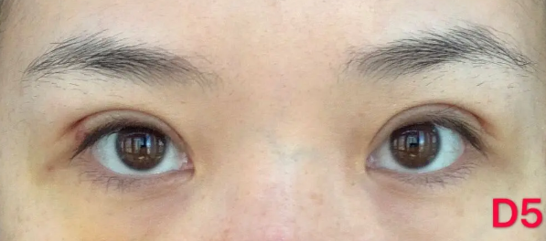 北京八大处整形医院郭时伟医生双眼皮怎么样?