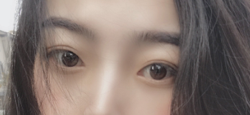 上海九院张英医生割双眼皮技术怎么样?