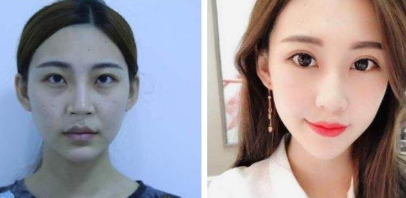 沈阳杏林整形医院王贵雄双眼皮怎么样?