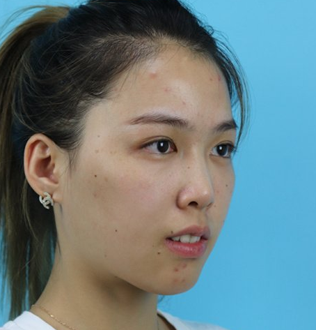 八大处刘暾做鼻子怎么样?案例|点评