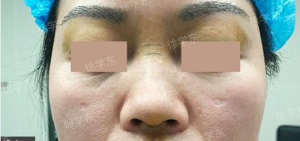 北京画美医院徐学东隆鼻怎么样?案例|点评
