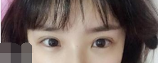 徐州医科大学附属第三医院倪西玲割双眼皮怎样