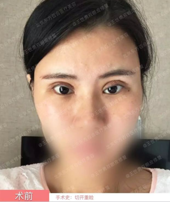 北京东方百合王世勇做双眼皮修复怎么样？