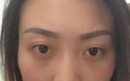 无锡二院朱小红医生去眼袋怎么样？案例|点评