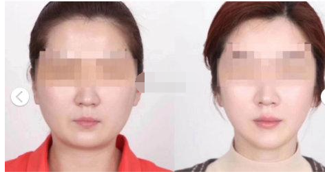 上海美联臣整形医院金振珸磨骨怎么样?