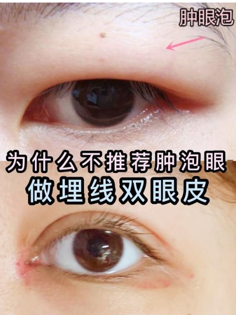 北京301医院李丹医生做双眼皮怎么样?