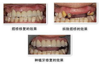 成都青羊圣贝口腔医院陈可矫正牙齿果怎么样