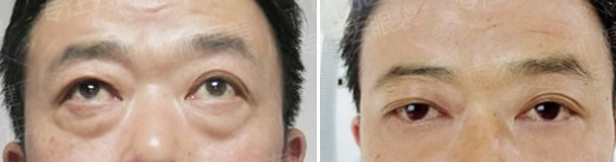 郑州健丽整形美容去眼袋怎么样?案例|价格