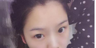 北京艾玛整形医院李方奇做双眼皮怎么样?
