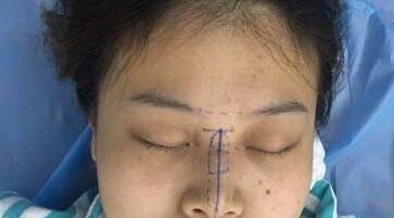 成都玉之光医疗美容黄开亮做隆鼻怎么样?