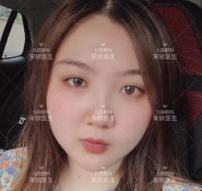 上海第九医院宋欣割双眼皮怎么样?案例|点评