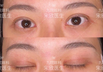 上海第九医院宋欣割双眼皮怎么样?案例|点评
