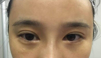 深圳鹏爱整形医院蔡国威割双眼皮怎么样?