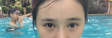 深圳鹏爱整形医院蔡国威割双眼皮怎么样?