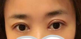 北京空军总医院双眼皮哪个医生好?案例|点评