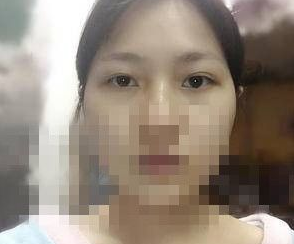 洛阳王静美容医院王静双眼皮怎么样?案例|点评