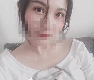 洛阳王静美容医院王静双眼皮怎么样?案例|点评