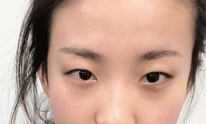河南省人民医院张黎做双眼皮怎么样?案例|点评