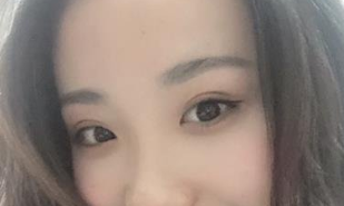 河南省人民医院张黎做双眼皮怎么样?案例|点评