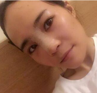 北京八大处刘暾隆鼻怎么样?案例|点评