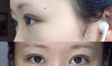 华西医院整形科孙本森做双眼皮怎么样?