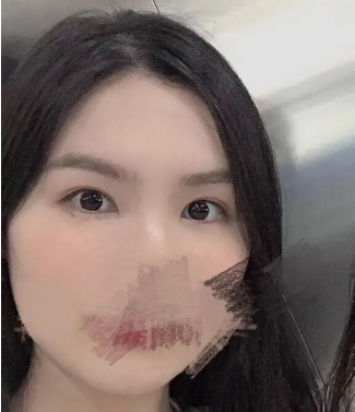 浙一医院范希玲割双眼皮怎么样?案例|点评