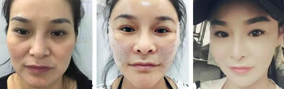 福州星龄整形黎护忠医生做脂肪填充怎么样?