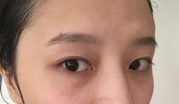 扬州艾菲斯整形医院黄婵做双眼皮怎么样?