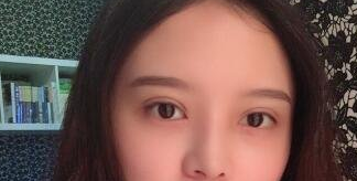 扬州艾菲斯整形医院黄婵做双眼皮怎么样?