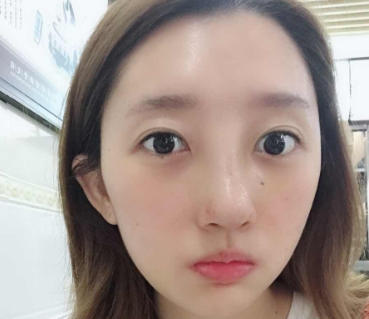 重庆华美医疗整形医院何超涛做隆鼻怎么样?