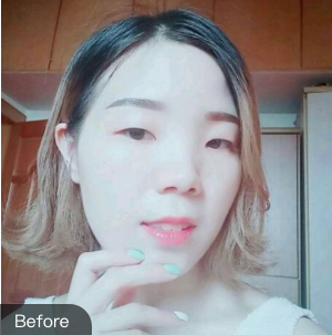 北京301医院李丹医生做双眼皮手术怎么样?