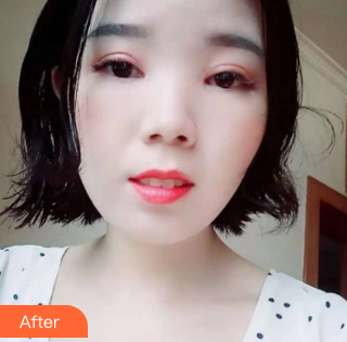 北京301医院李丹医生做双眼皮手术怎么样?