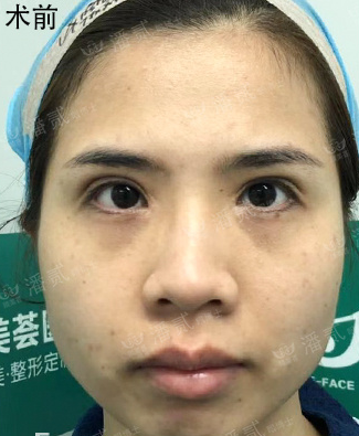 广州颜美荟医疗诊所潘贰做双眼皮修复怎么样?