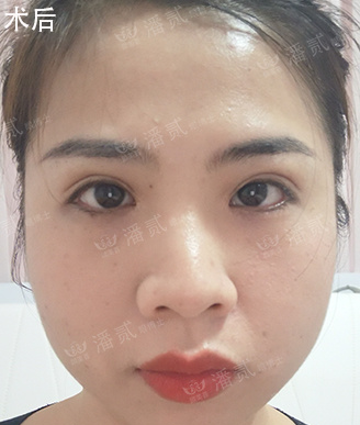 广州颜美荟医疗诊所潘贰做双眼皮修复怎么样?