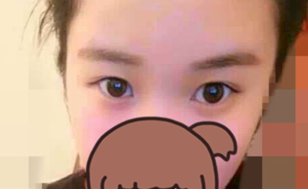 佳木斯美白美容医院做双眼皮手术怎么样?