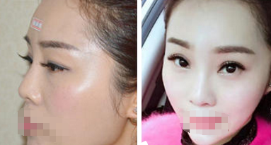 南京康美医美医院冯思阳做隆鼻手术怎么样?