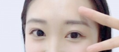 珠江医院整形科陈兵医生做双眼皮手术怎么样?