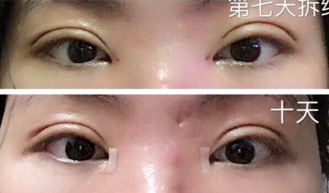 河南省人民医院张黎医生做双眼皮手术怎么样?