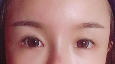 南阳天后整形医院做双眼皮手术好不好?案例|点