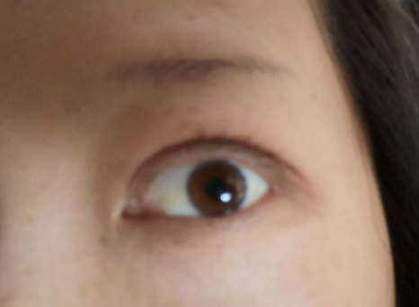 上饶尚美医疗美容刘育凤医生做双眼皮怎么样?