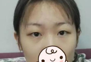 昆山百达丽整形美容医院双眼皮手术怎么样?
