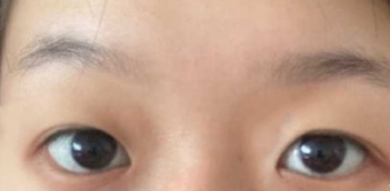 上海九院北部王俊芳医生双眼皮+内眼角案例