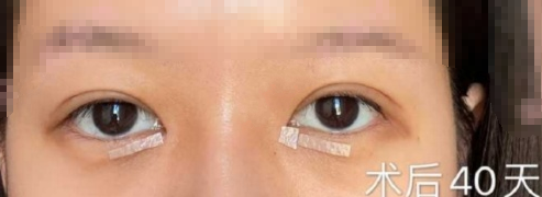 上海九院北部王俊芳医生双眼皮+内眼角案例