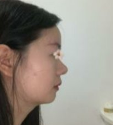 先调鼻子还是先调脸型比较好呢?