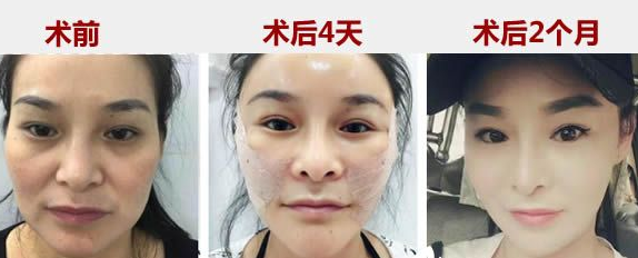 福州星龄整形黎护忠医生脂肪填充怎么样?