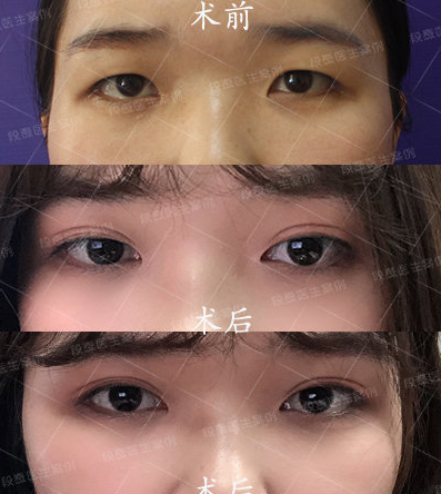 西区医院段焘做双眼皮怎么样?