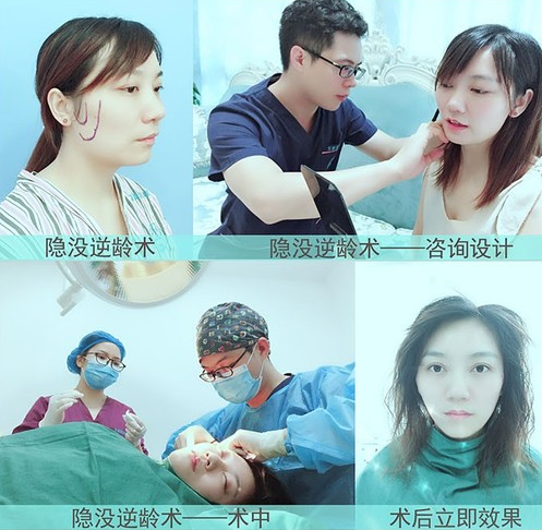 文星医生集团何文星做双眼皮手术怎么样?