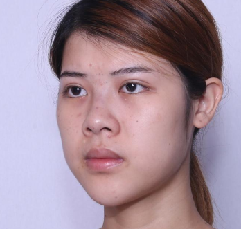 广州曙光医院耳软骨复合隆鼻案例分享!
