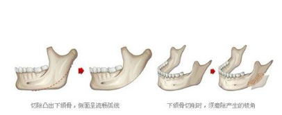 有哪些方法可以改良下颌角？